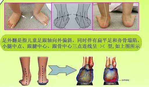 宝宝足外翻怎么办 足外翻影响孩子的正常身高发育吗 足外翻 宝宝足外翻怎么办 足外翻影响孩子的正常身高发育吗 足外翻