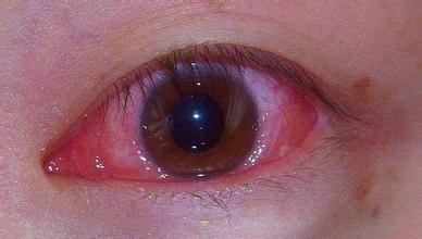 虹膜炎症状 早期症状图片