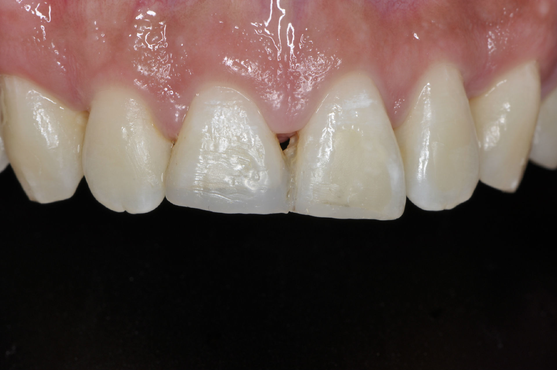 笔者结合其牙齿一般检查情况及x线片检查情况发现该患者右上中切牙