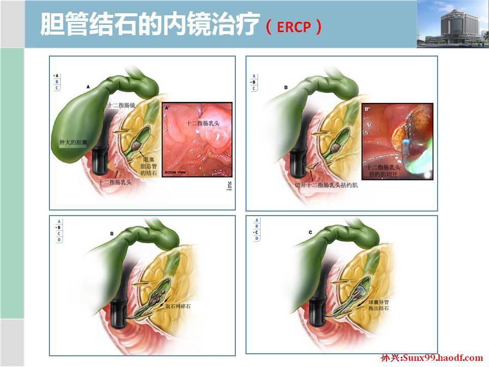 且膽道引流管尚未拔出的病人,通過引流管竇道,利用膽道鏡可以將肝膽管