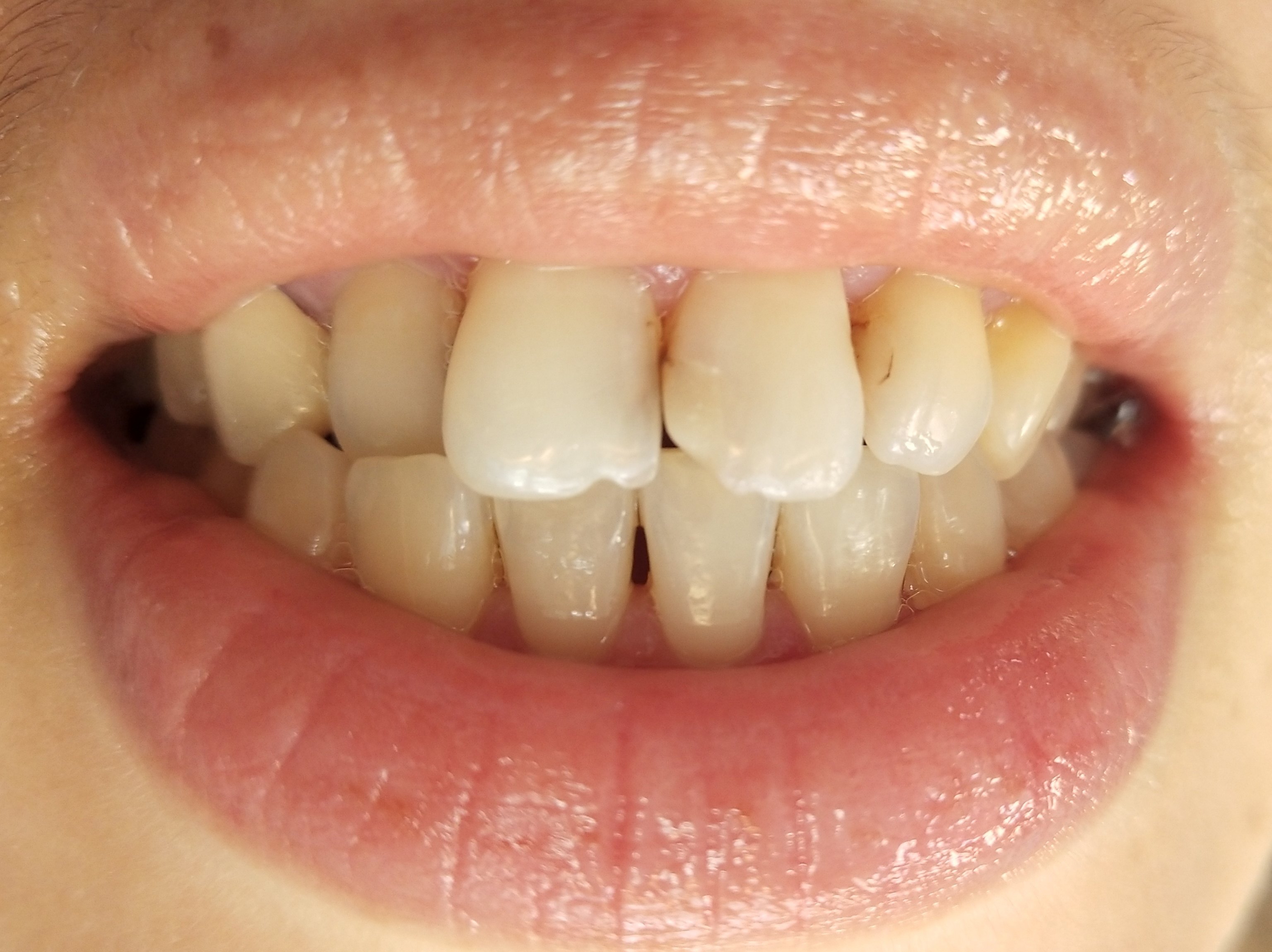 门牙龋齿图片图片