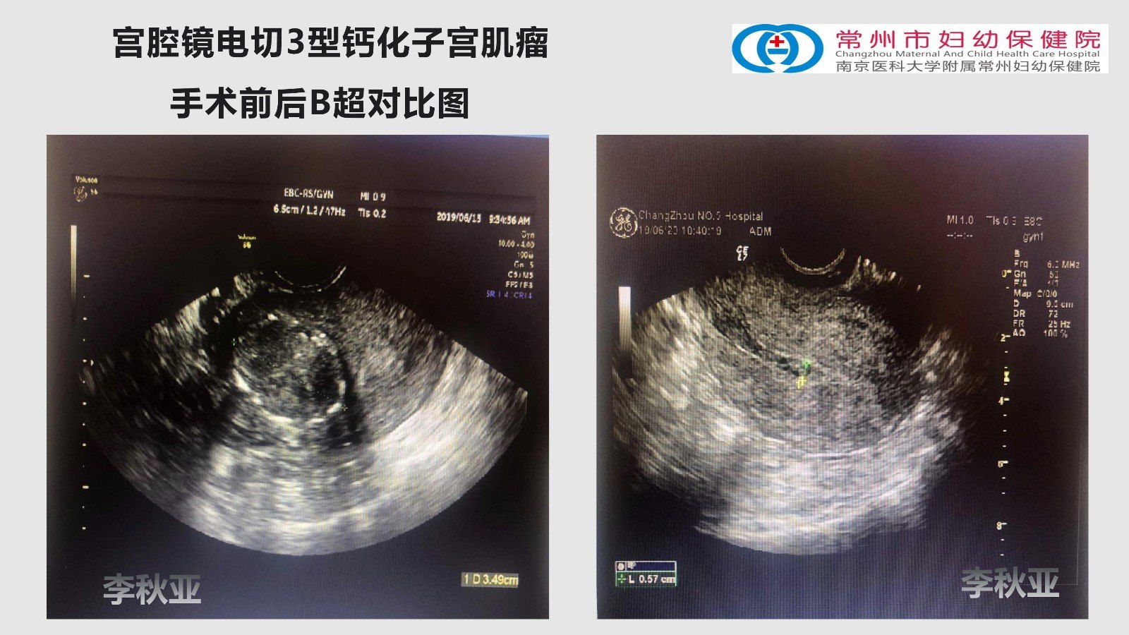 宫腔镜电切钙化肌瘤图片_02.jpg