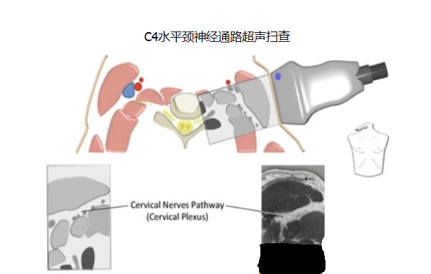 详解最新颈丛神经阻滞方法 - 好大夫在线