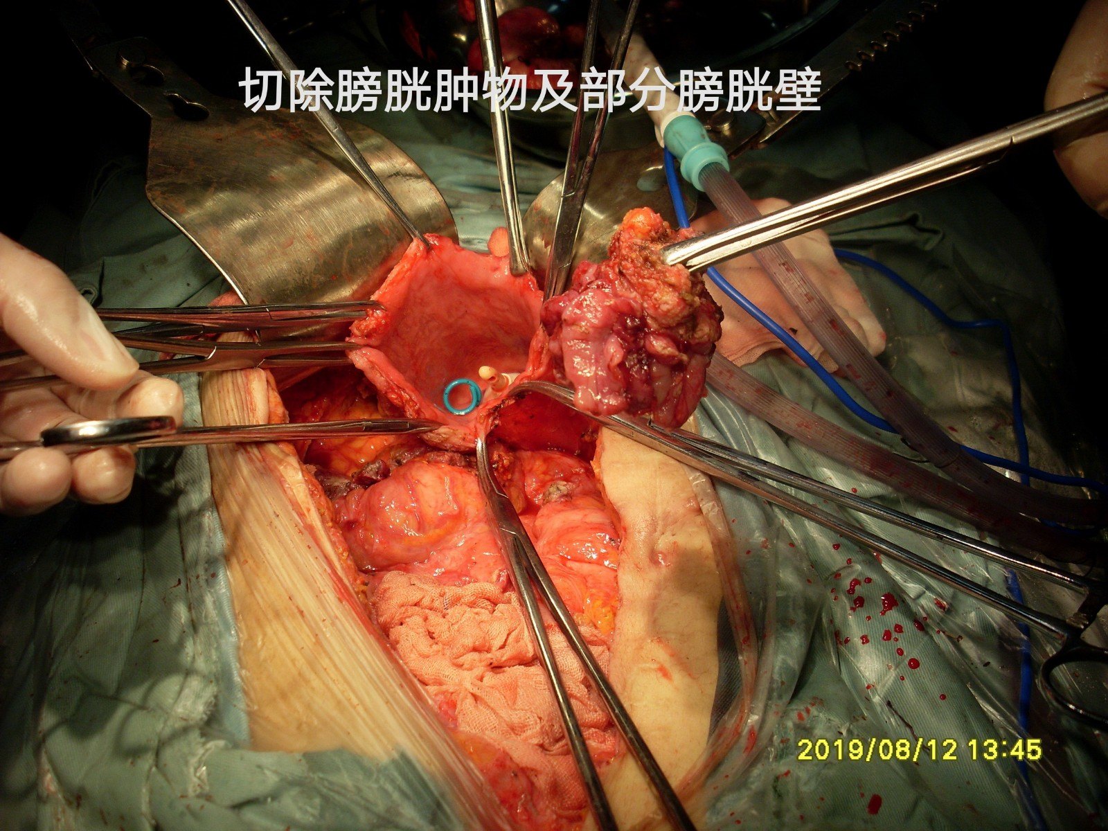 病例113--阑尾炎脓肿实为阑尾腺癌直接浸润累及右侧腹壁,卵巢,膀胱伴
