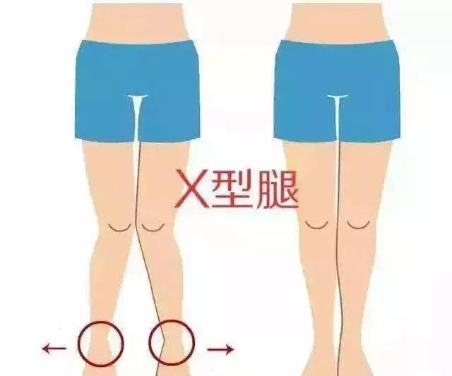 小孩8岁还是x型腿 该如何有效矫正 X型腿 X型腿 小孩8岁还是x型腿 该如何有效矫正 X型腿 X型腿