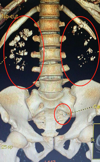 髓質海綿腎與腎結石