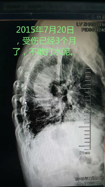 经皮椎体成形术操作技术专家共识和病例共享