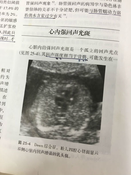 胎儿心室强光斑原委