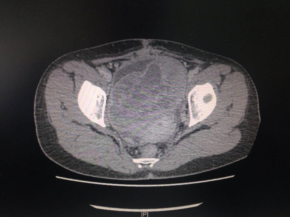巨大膀胱肉瘤根治术一例