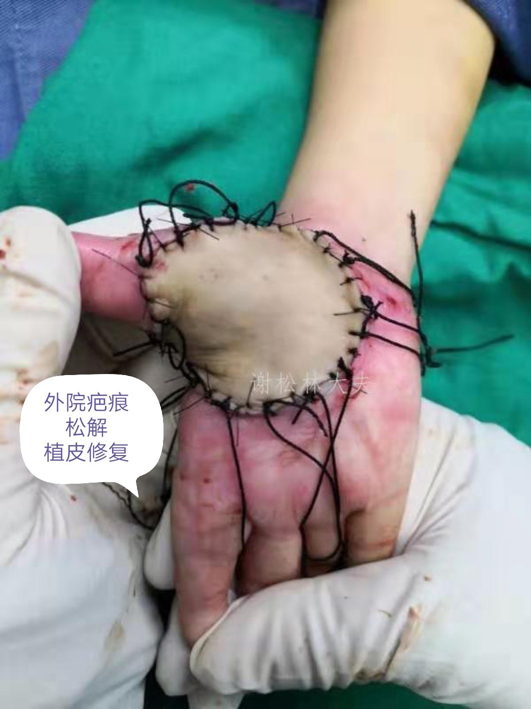 大面积疤痕,深层疤痕和疤痕体质的治疗需要综合治疗,手术治疗是有效