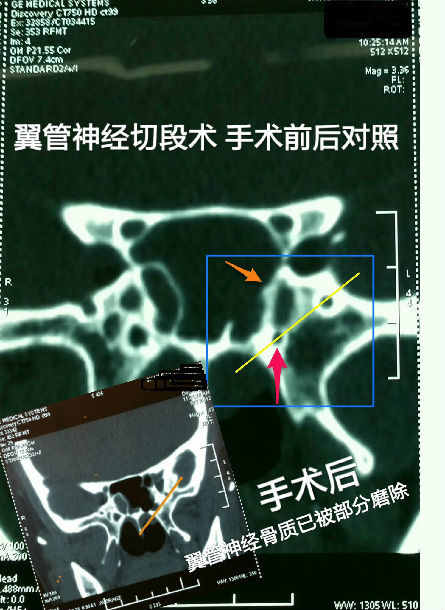 鼻内镜下蝶窦腔内翼管神经切断术治疗过敏性鼻炎
