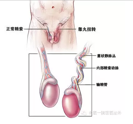 睾丸扭转 那些事儿 睾丸扭转 疾病介绍