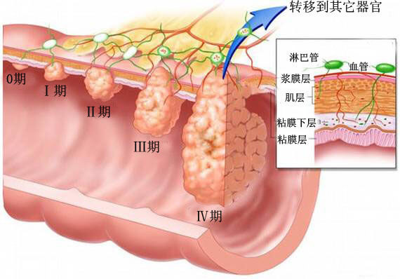 大腸粘膜出現過度增生;過度增生粘膜慢慢形成了小的腺瘤性息肉;息肉逐