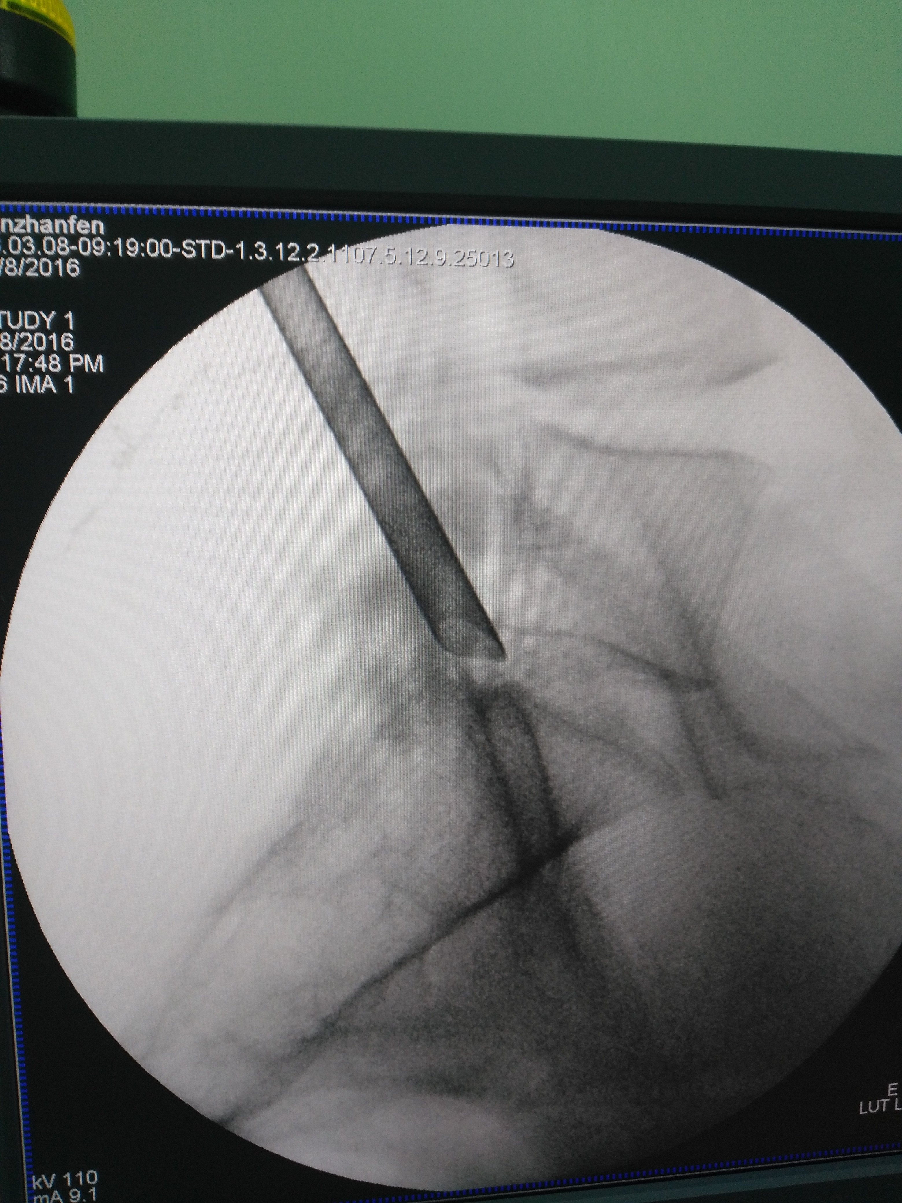 近日完成多例椎间孔镜治疗腰椎间盘突出症 - 好大夫在线