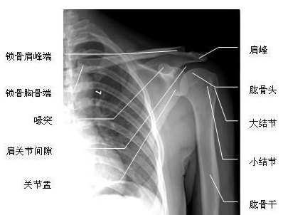 立医院 张文卿 文章列表 肩袖损伤:是指围绕肱骨头肩袖组织的撕裂损伤