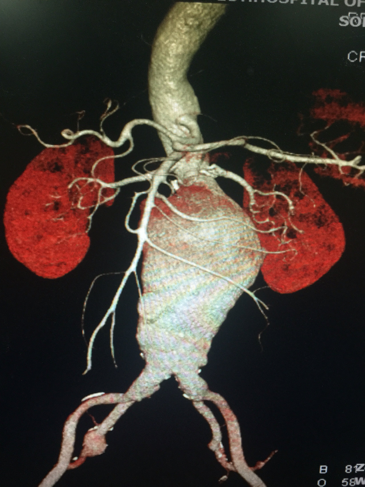 腹部主动脉血管瘤图片