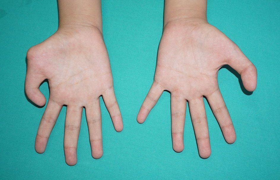 儿童拇手指畸形矫正应该重视截骨的细节典型病例