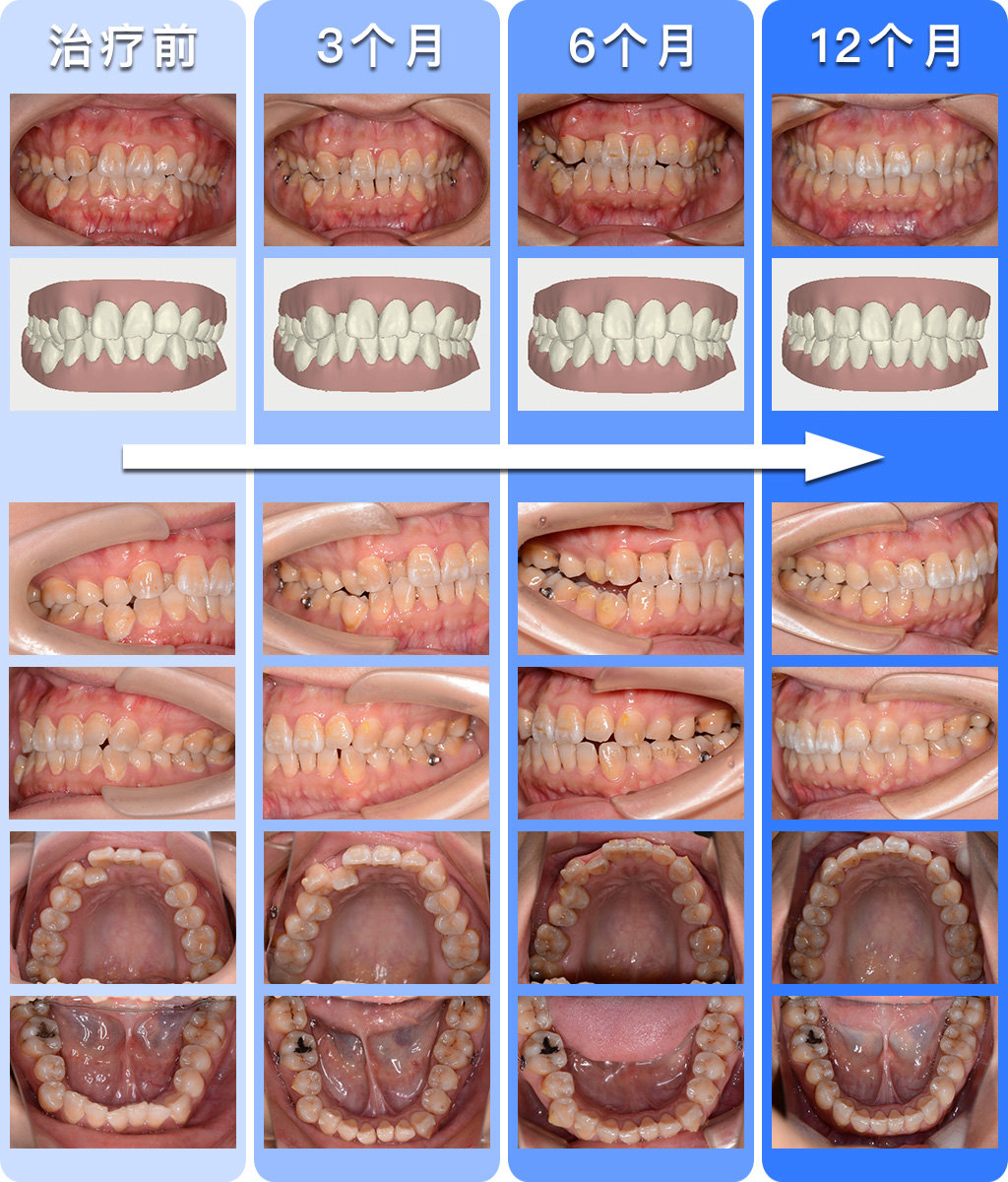 透明牙套推磨牙向后高效矫治拥挤病例—无托槽隐形矫治