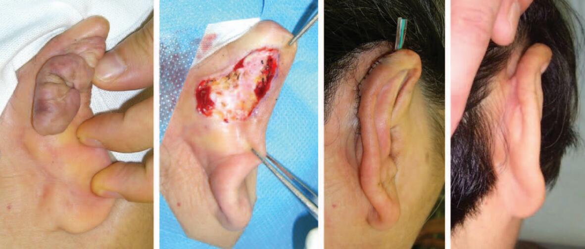 耳廓瘢痕疙瘩怎么治疗八大处整形于晓波医生