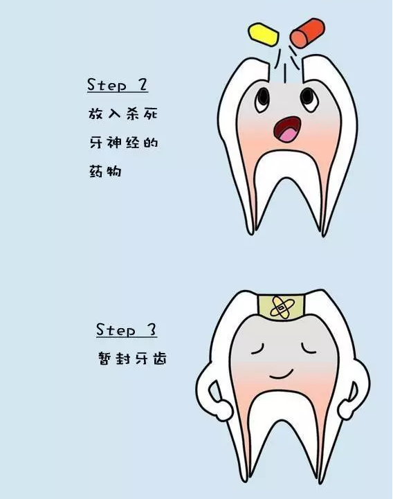 咱们来聊聊——根管治疗 - 好大夫在线