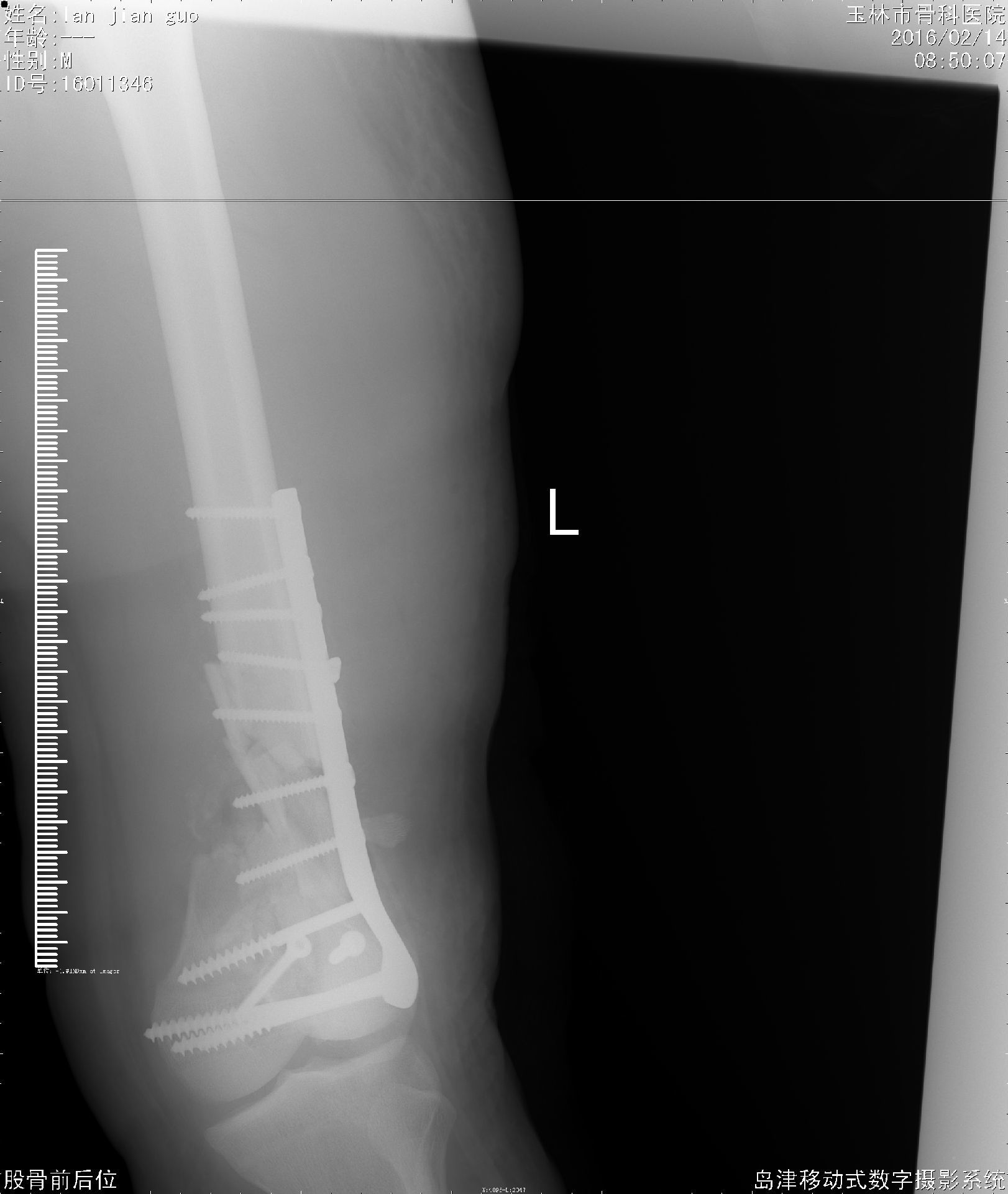 复杂性关节骨折治疗