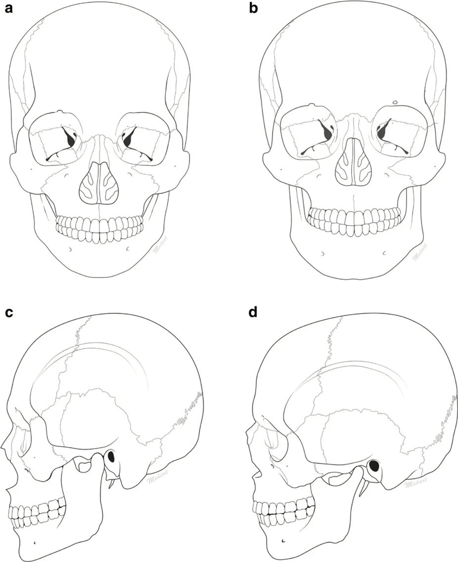 亞洲人(a,c)與西方人(b,d)骨骼結構對比