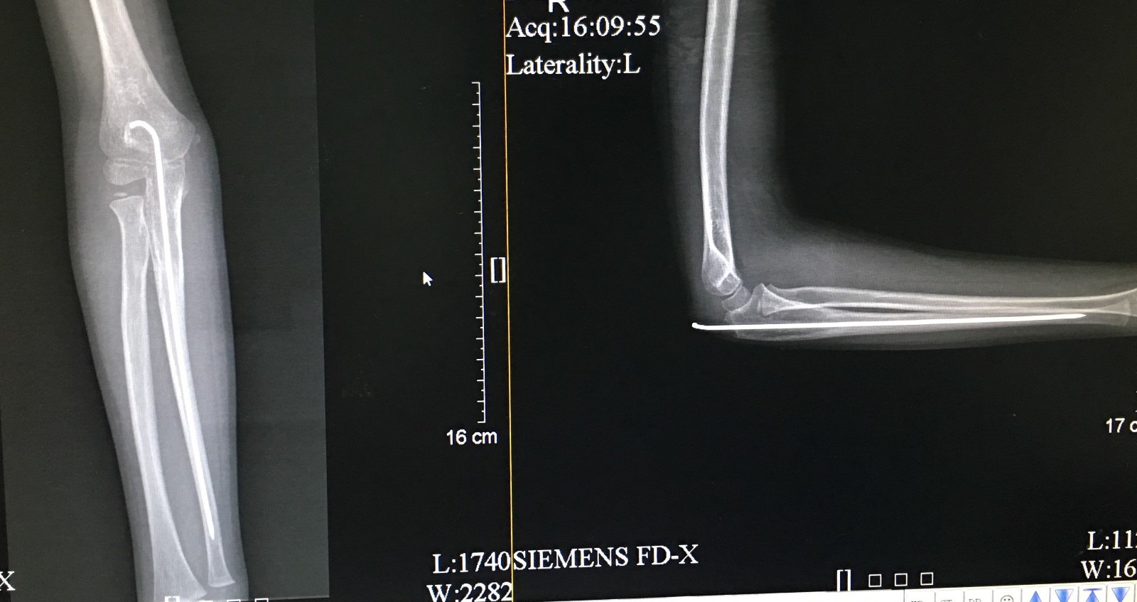 病例2 患者,男6歲,尺骨近端骨折並橈骨小頭脫位本文是黎潤光版權所有