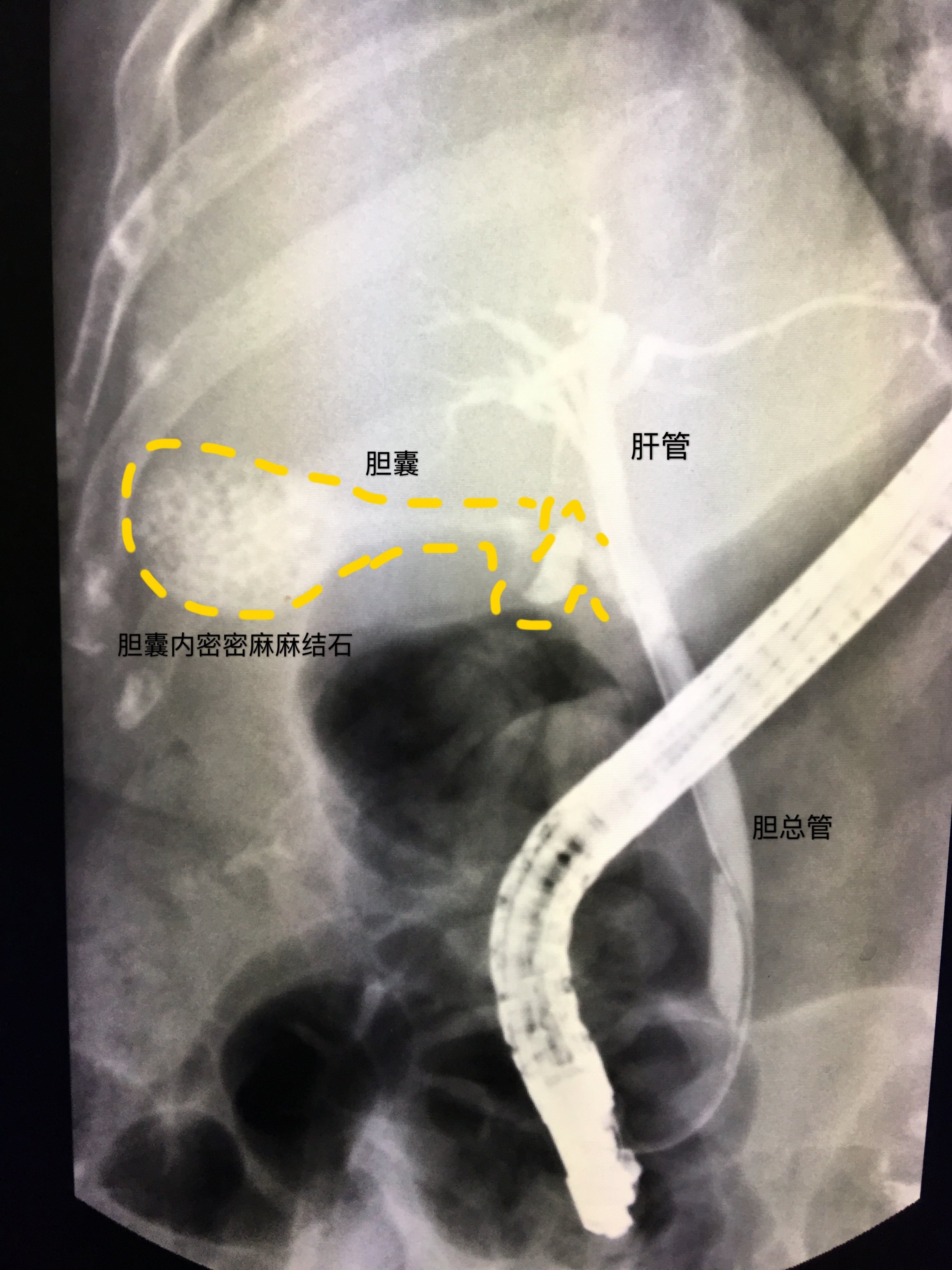 胆囊结石影像图片