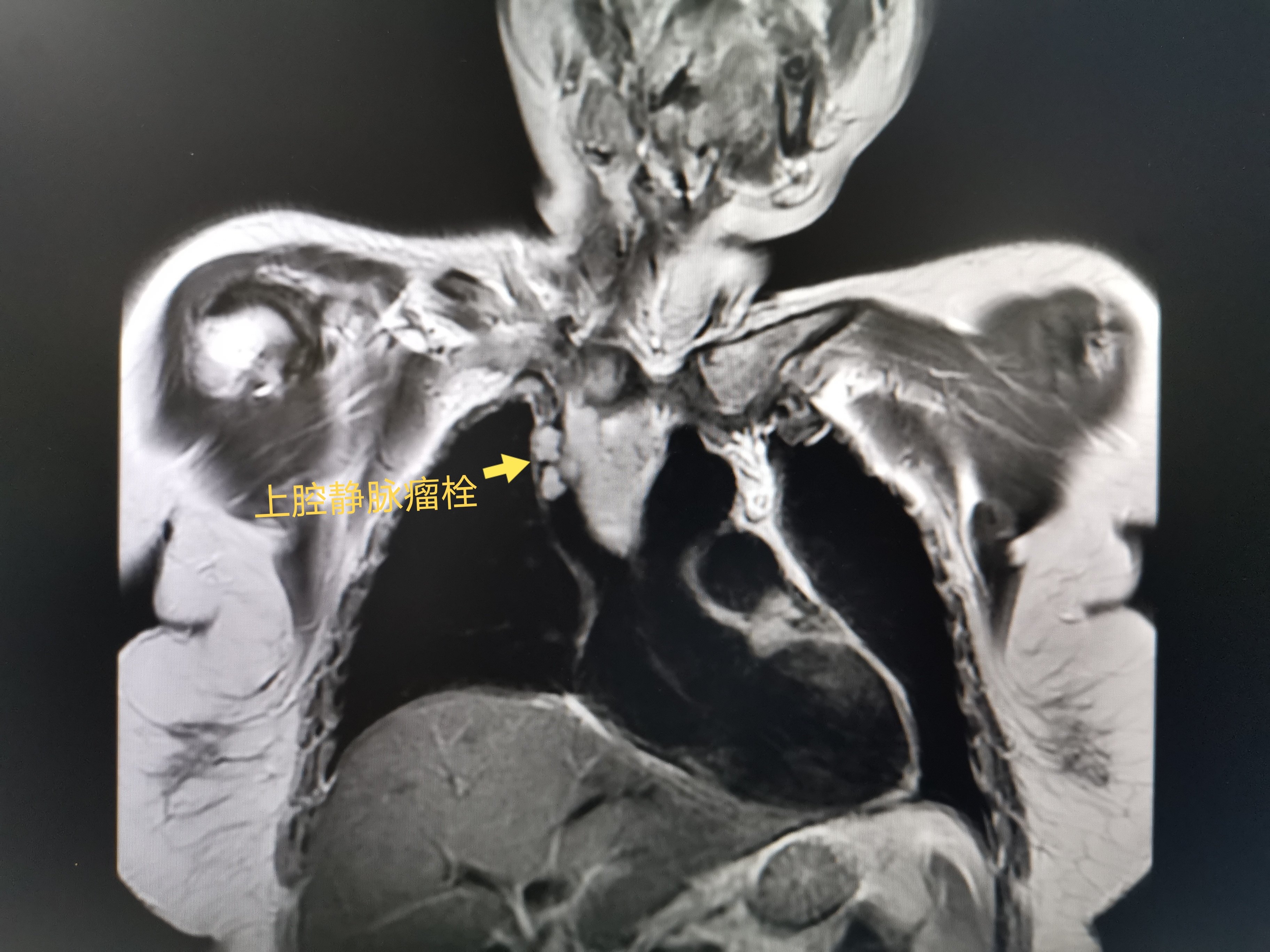 甲状腺癌外院术后颈部及纵隔淋巴结转移侵及右无名静脉上腔静脉瘤栓