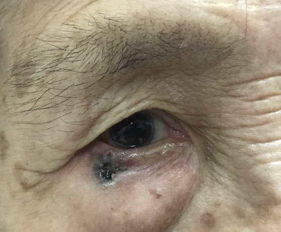眼部肿瘤科普系列之 眼皮上长东西要不要紧之眼睑良性肿瘤