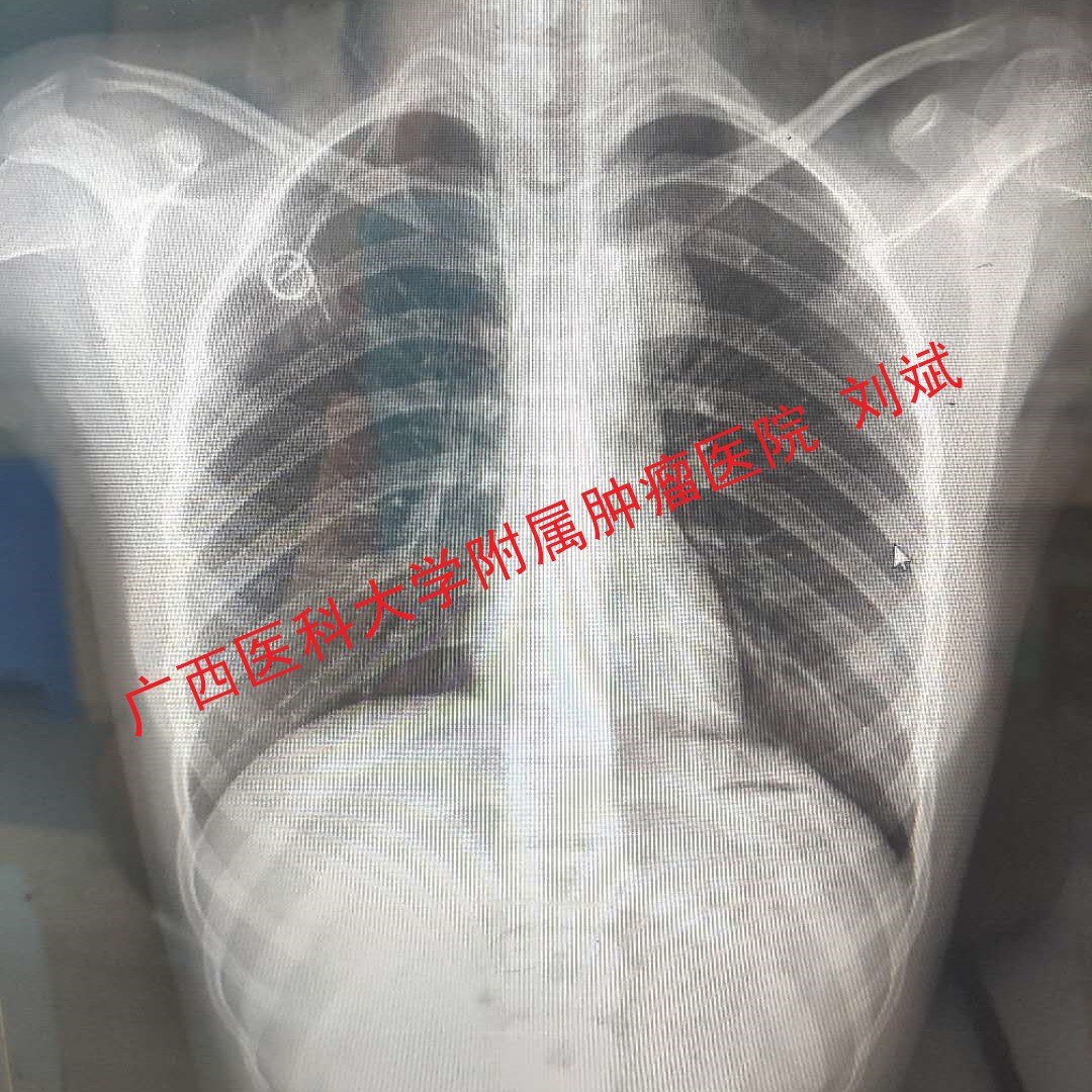 临床上又称 port,是一种专业的输液设备,用于缓解药物对病人血管的