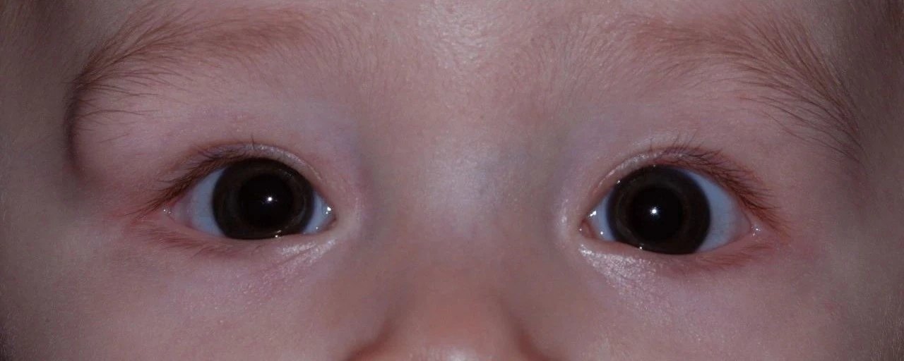 婴儿眉骨囊肿图片图片