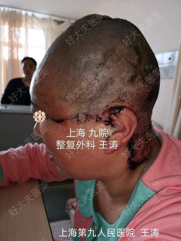 皮瓣移植