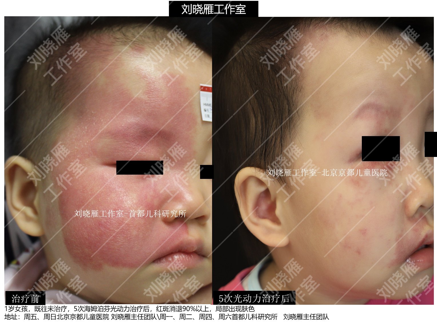 海姆泊芬光动力治疗鲜红斑痣儿童病例展示图片 - 好大夫在线