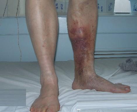 大腿静脉炎早期图片图片