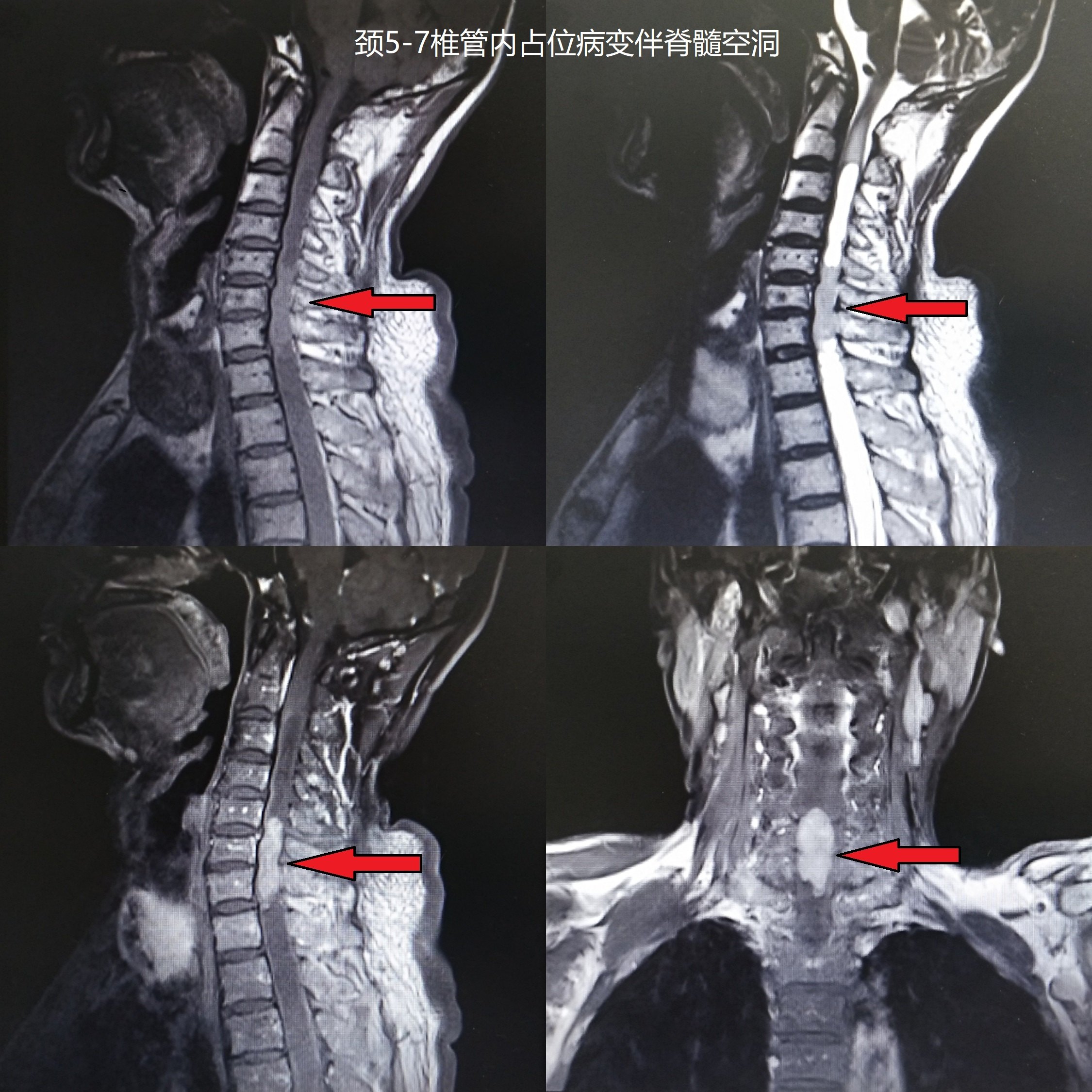 颈椎室管膜瘤图片
