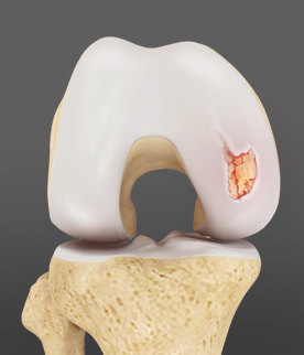 articular-cartilage-defect1.jpg