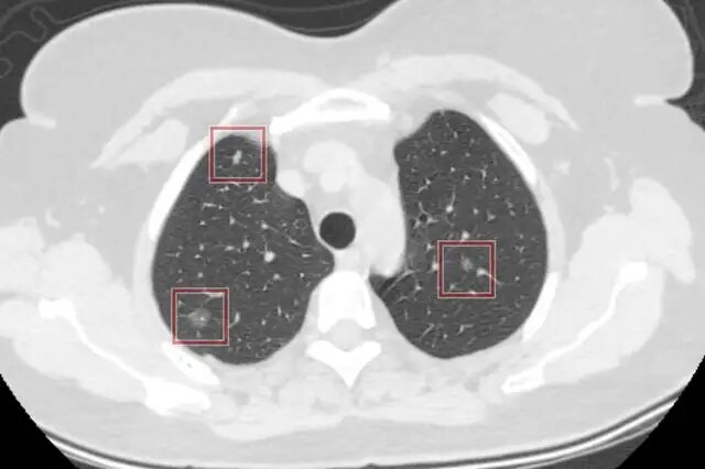 磨玻璃结节 磨玻璃结节