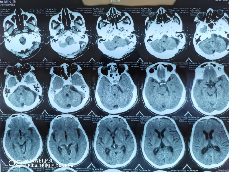 因此,对于怀疑三叉神经痛的患者,一定要做三叉神经的核磁共振扫描