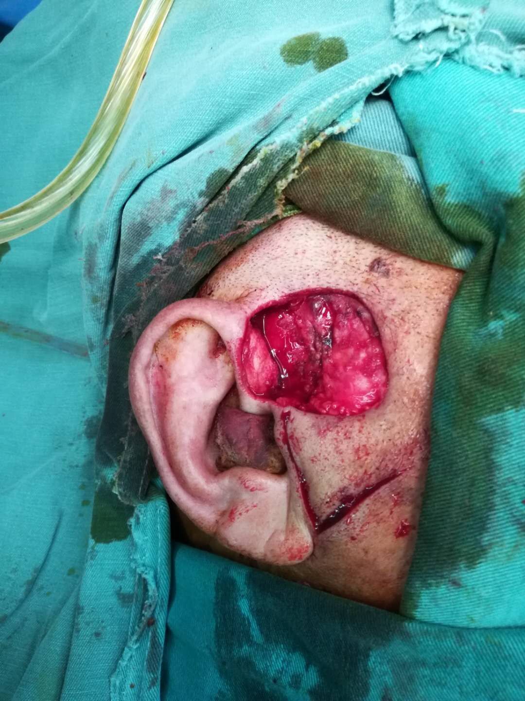耳前肿物切除加局部皮瓣修复 