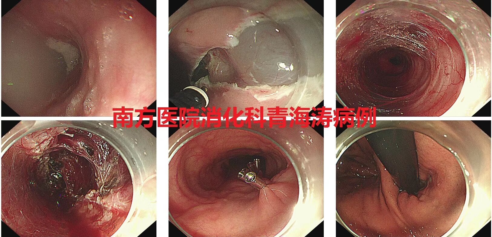 青海涛教授完成2例内镜下手术治疗贲门失弛缓,贲门黏膜下肿瘤