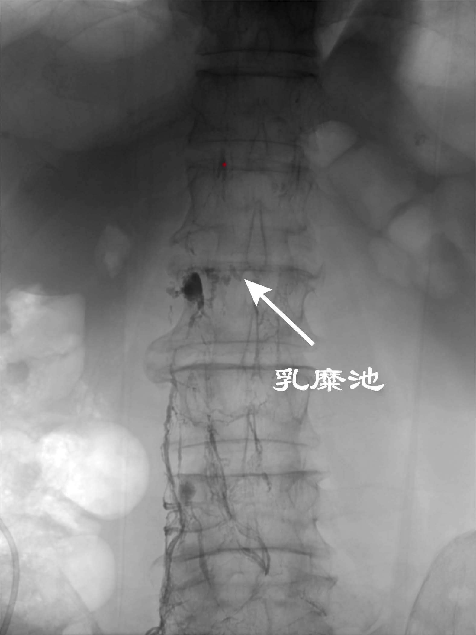 乳腺导管瘘的图片图片