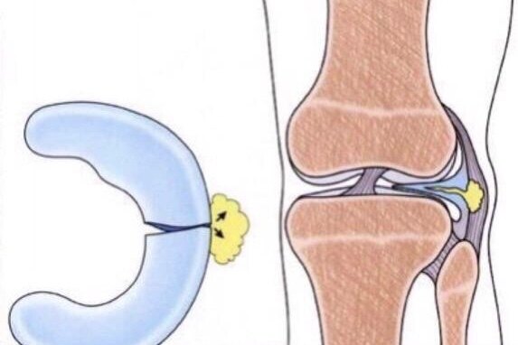 膝关节半月板囊肿 膝关节半月板损伤 好大夫在线
