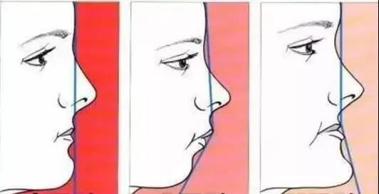 通过山根做一条垂直于水平线的虚线,然后在鼻唇角的拐点处标出鼻下点