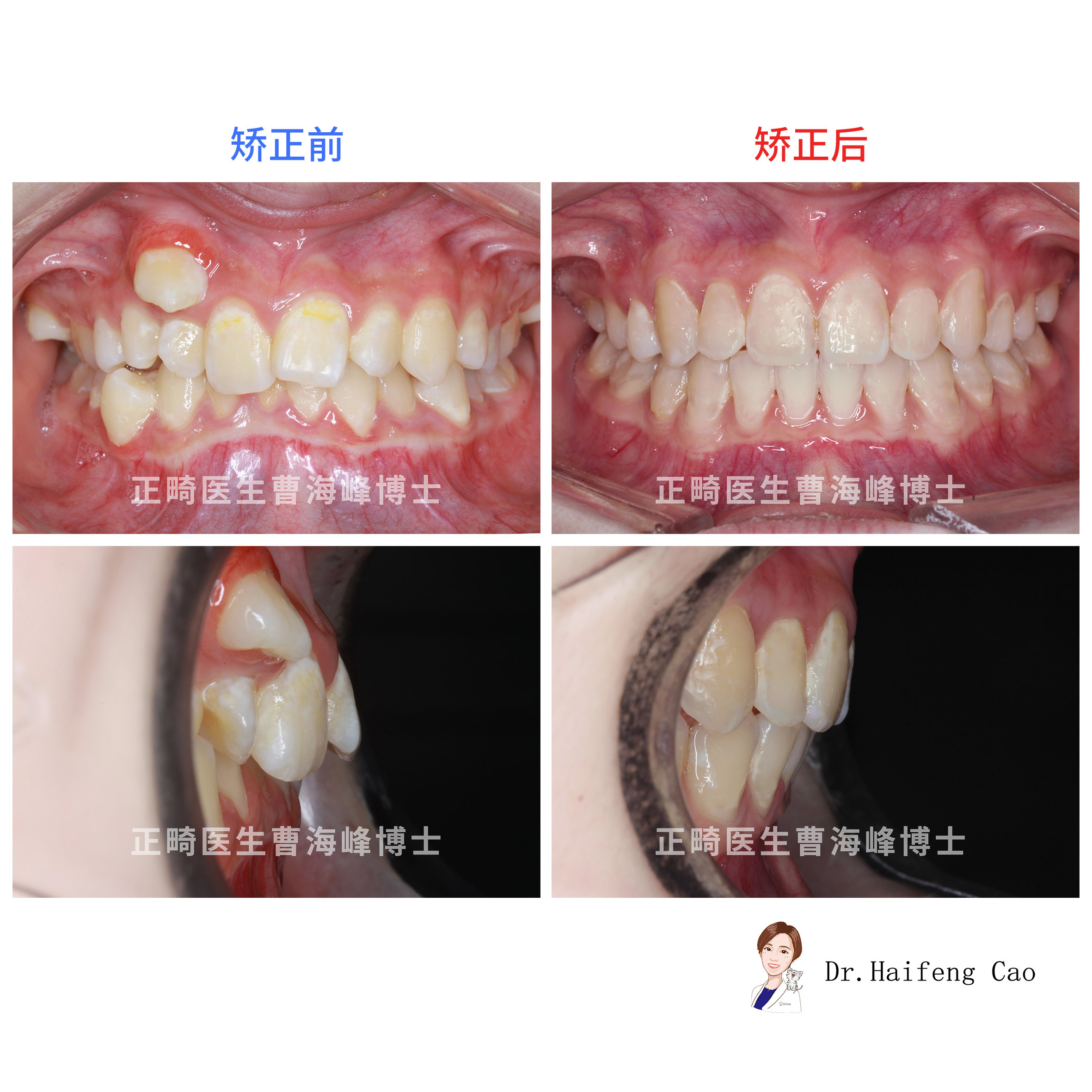 牙齿拥挤牙不齐矫正案例