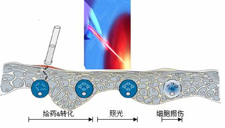 艾拉光动力(ala-pdt)治疗系统 ——尖锐湿疣首选治疗方案_尖锐湿疣