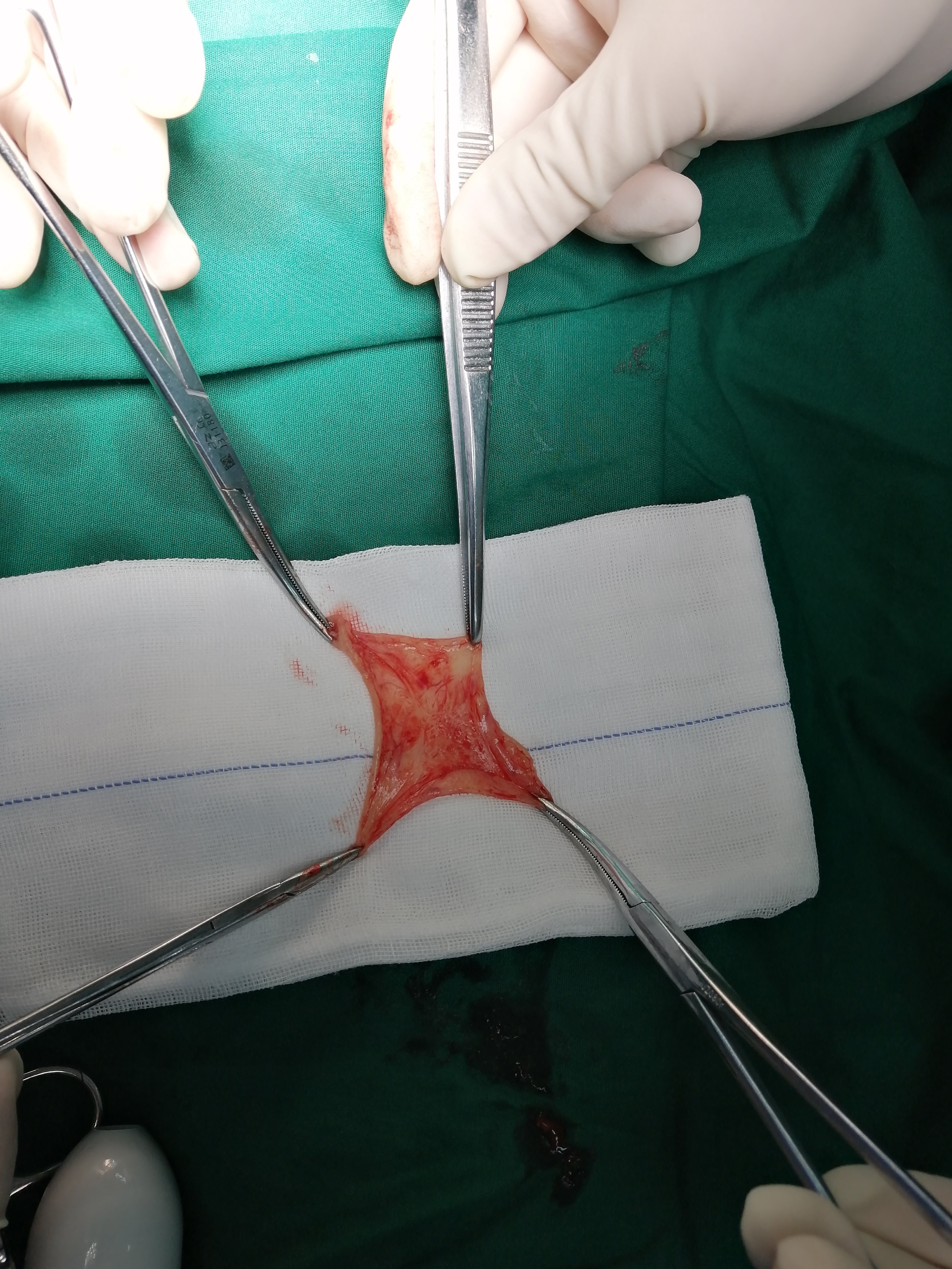 便秘之结肠慢传输合并直肠前突的微创手术治疗 - 好大夫在线