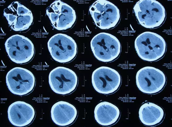 管后第3天即2015年6月24日中午,复查头ct显示脑室扩张较前加重(图-5)