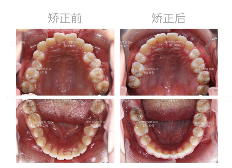 智齒牽引替代磨牙案例_牙頜畸形_牙頜畸形治療方式 - 好大夫在線