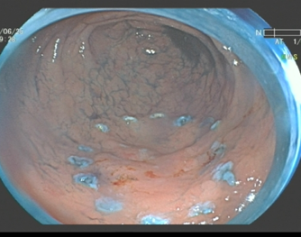 早期胃癌胃高级别上皮内瘤变胃黏膜异型增生治疗新技术内镜黏膜下剥离
